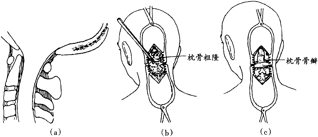第一節(jié) 枕寰關(guān)節(jié)損傷